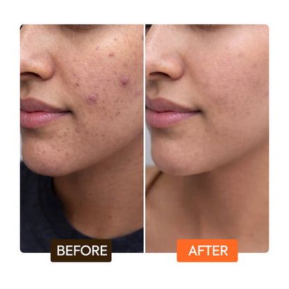 Before and after comparison of a person's face with visible skin improvement. | Makari de Suisse Uganda